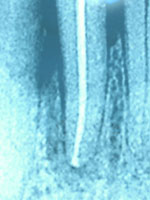endodonzia